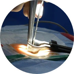surgical error